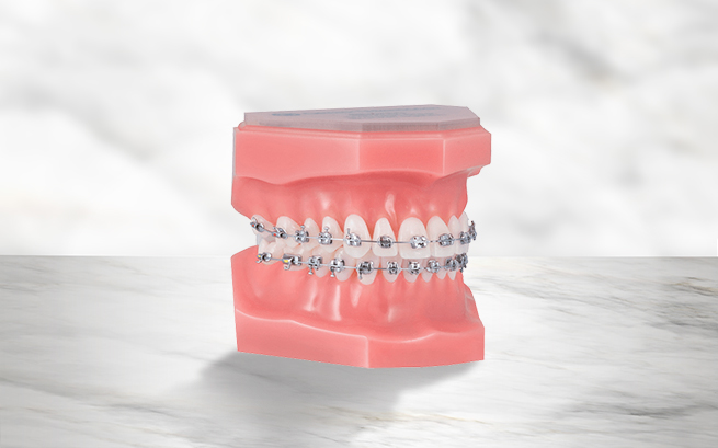 Regular metal braces in playa-del-carmen